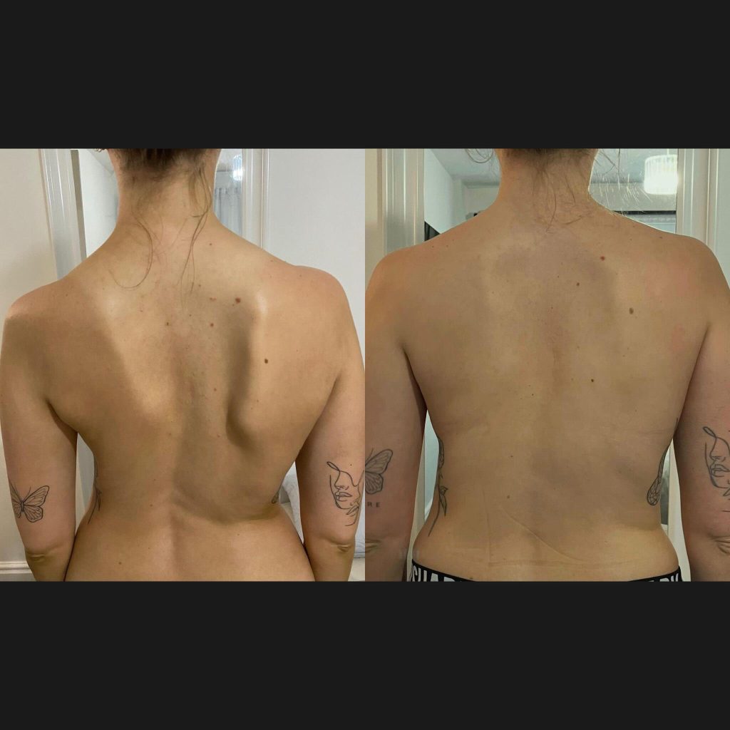 Scoliosis results